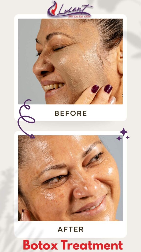 Botox Before and after for botox price in Nepal - Lucent skin and hair clinic, Nepal