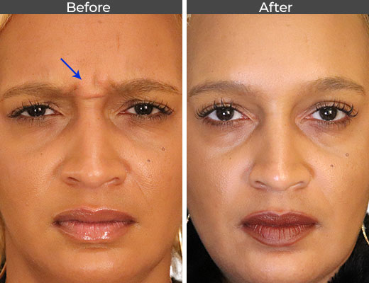Botox Hair Treatment Before and After
