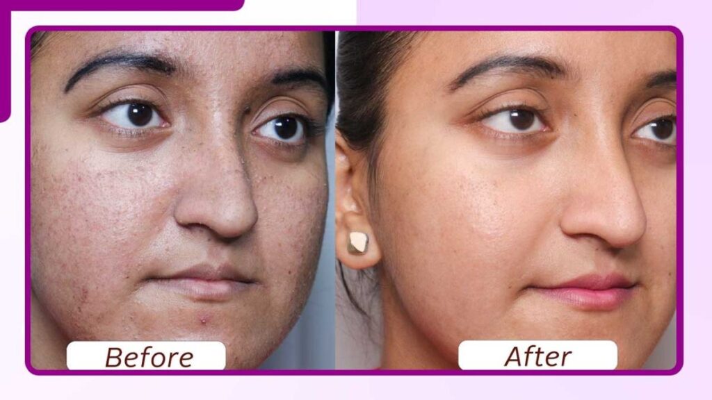 before and after carbon peel treatment result