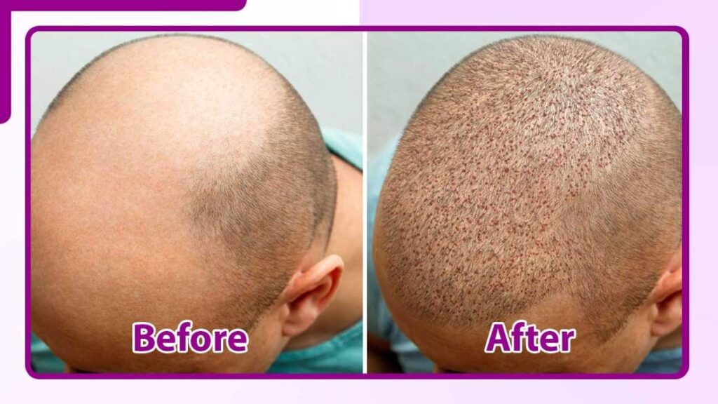 hair transplant before and after result