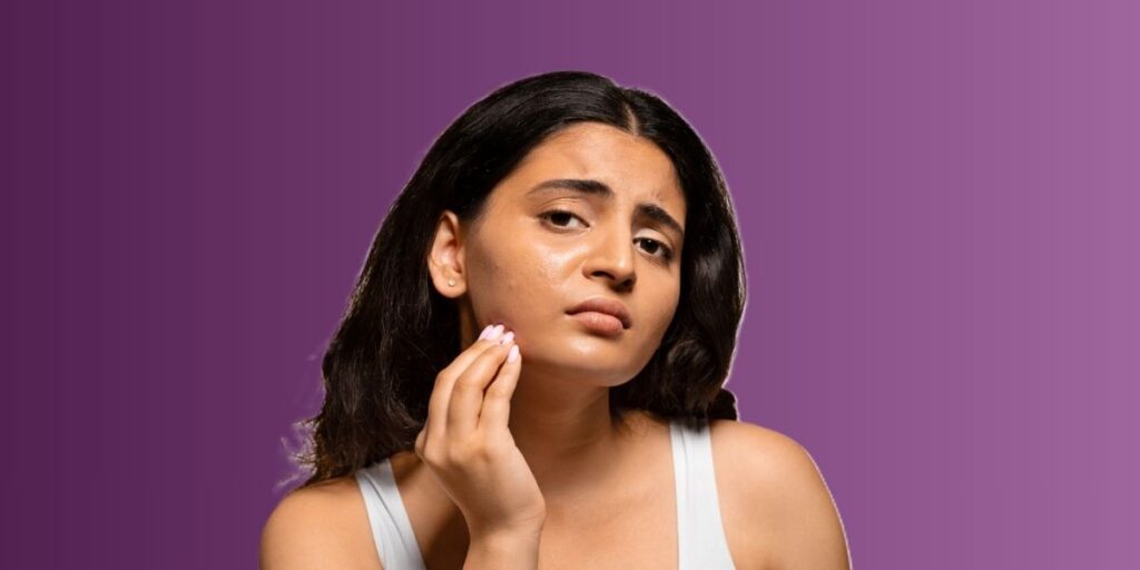 woman suffering from hyperpigmentation & needs treatment in nepal