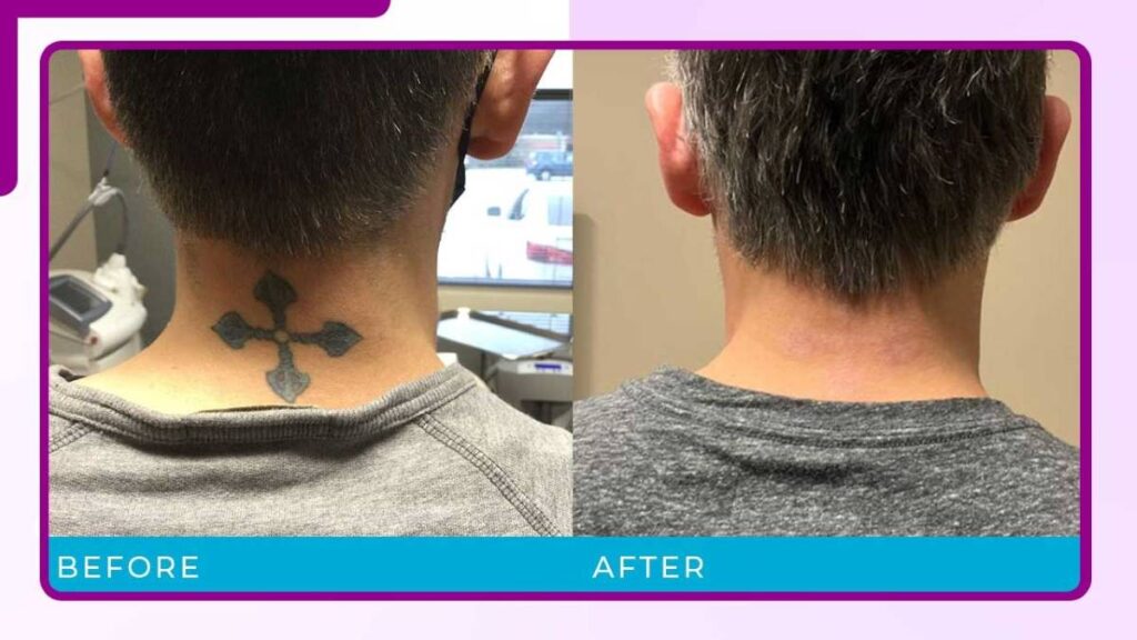tattoo removal before and after comparison picture