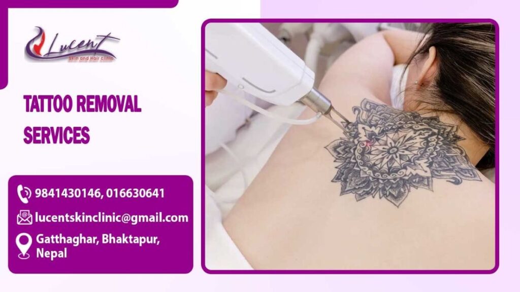 Tattoo Removal Services in Nepal – Safe, Effective & Advanced Laser Treatment
